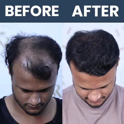 Hair Transplant