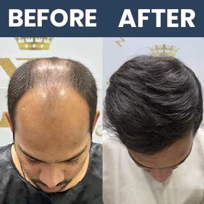 Hair Transplant