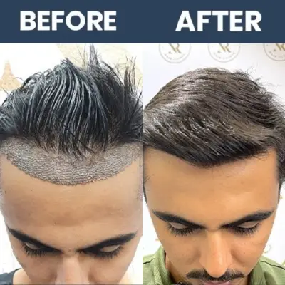 No Shave Hair Transplant