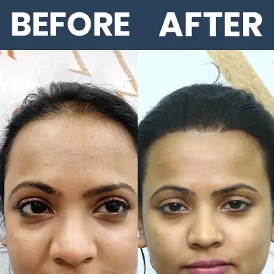 Female Hair Transplant