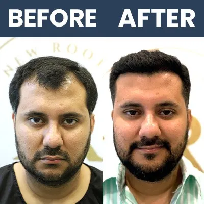 Swift Hair Transplant